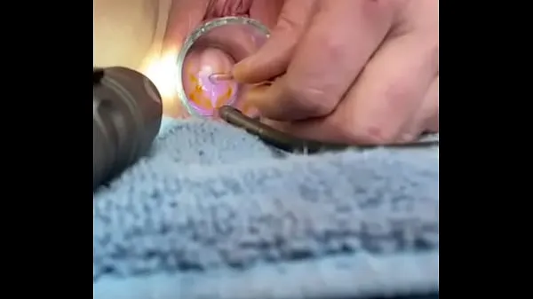 Isoja Advancing 6mm sound in cervix w cramping tuoretta videota