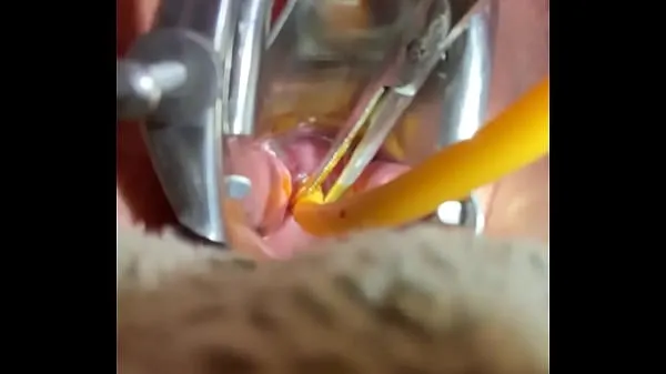 Veliki Inserting Foley into cervix sveži videoposnetki