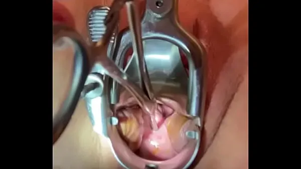大Sound tenaculum applying traction to cervix新鲜的视频