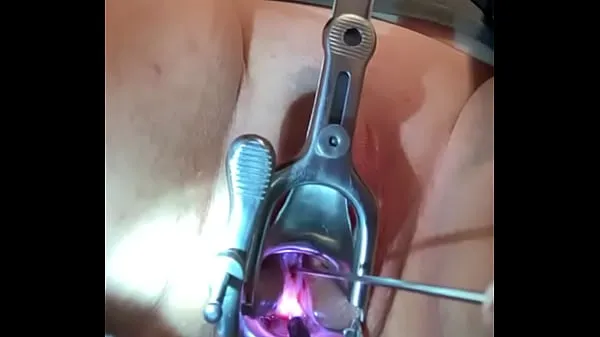 大Dilator penetrates internal os of cervix新鲜的视频