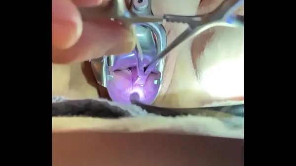 Big Dentes do tenáculo mordem no colo do útero vídeos frescos