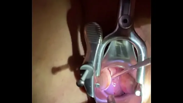 Große Einsetzen von Schall Tenaculum in den Gebärmutterhals frischen Videos