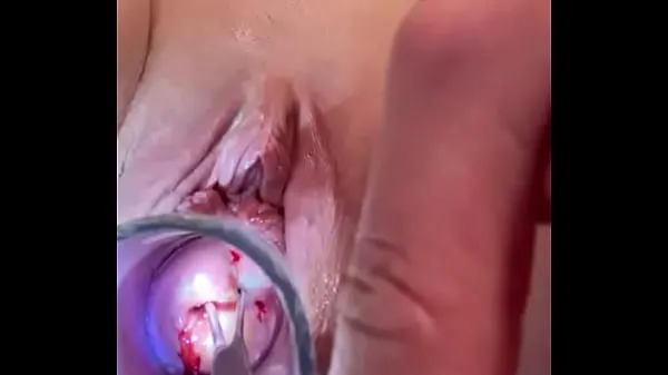 Video besar Cervix tor ture w tenaculum sounding segar