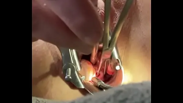Stora Holding cervix w tenaculum while 8mm dilator fucks uterus färska videor
