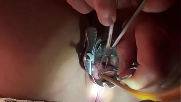 大Tenaculum grasping cervix for catheter新鲜的视频