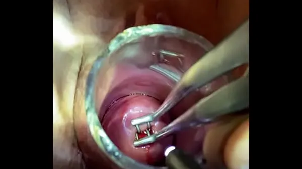 Veľké Rosebud into uterus via endocervical speculum čerstvé videá